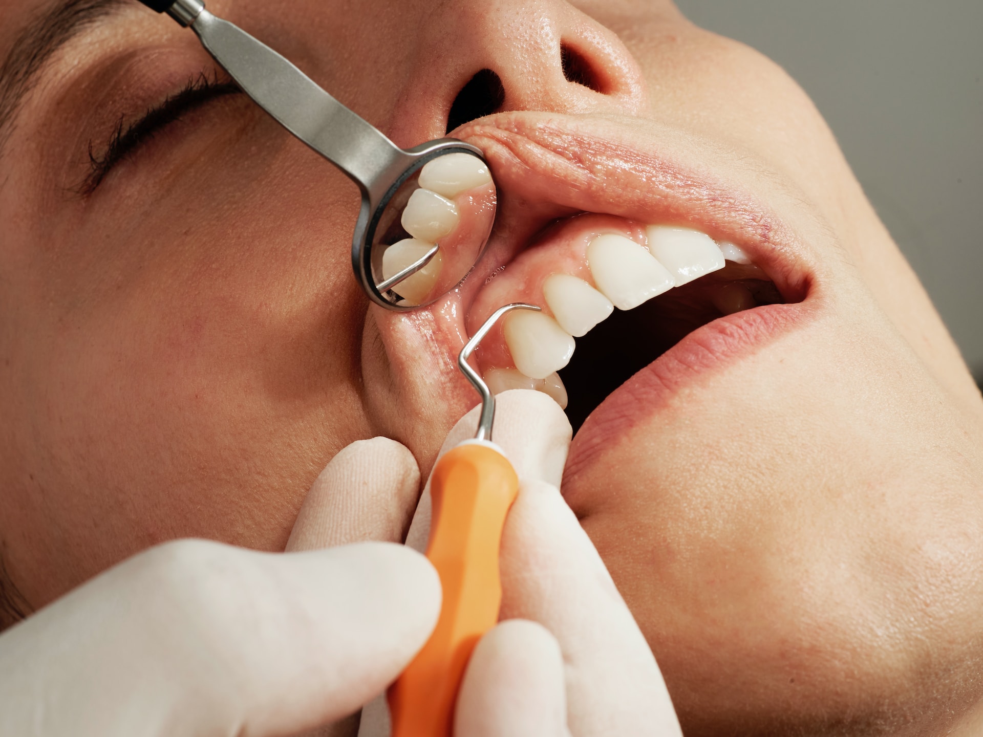 Wackelnde Zähne bei Erwachsenen: Ursachen, Prävention und Behandlung